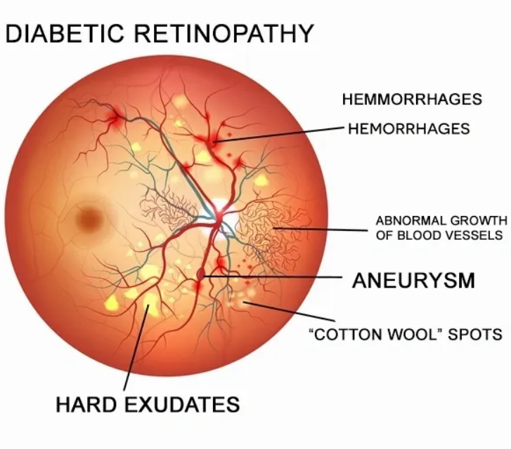 Диабеттік ретинопатия презентация